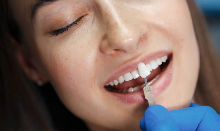 3 Life-Changing Benefits Of Veneers