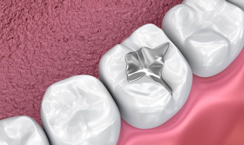 Dental Sealants