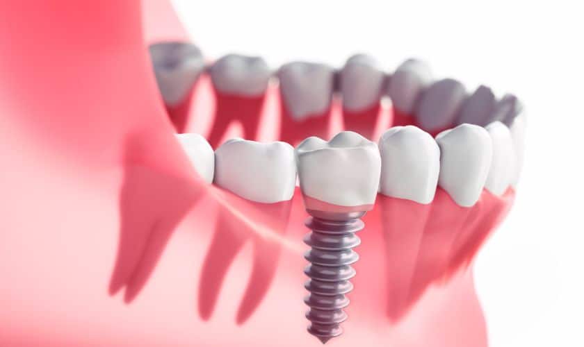 Jingle Bell Smiles: Celebrate Christmas With Dental Implant Joy