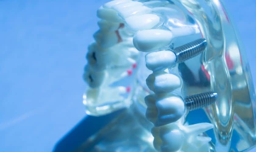 Dental Implants Colorado Springs