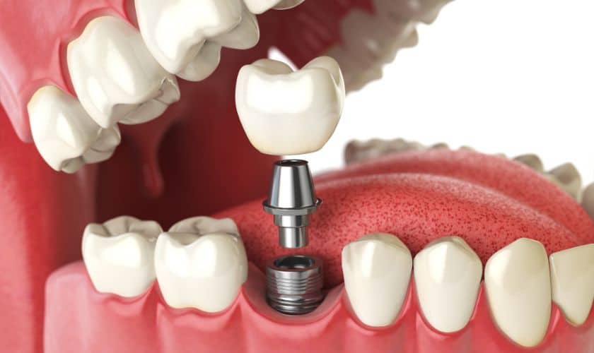 Dental Implants Colorado Springs