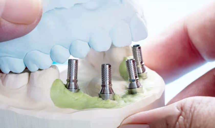 Dental Implants Colorado Springs