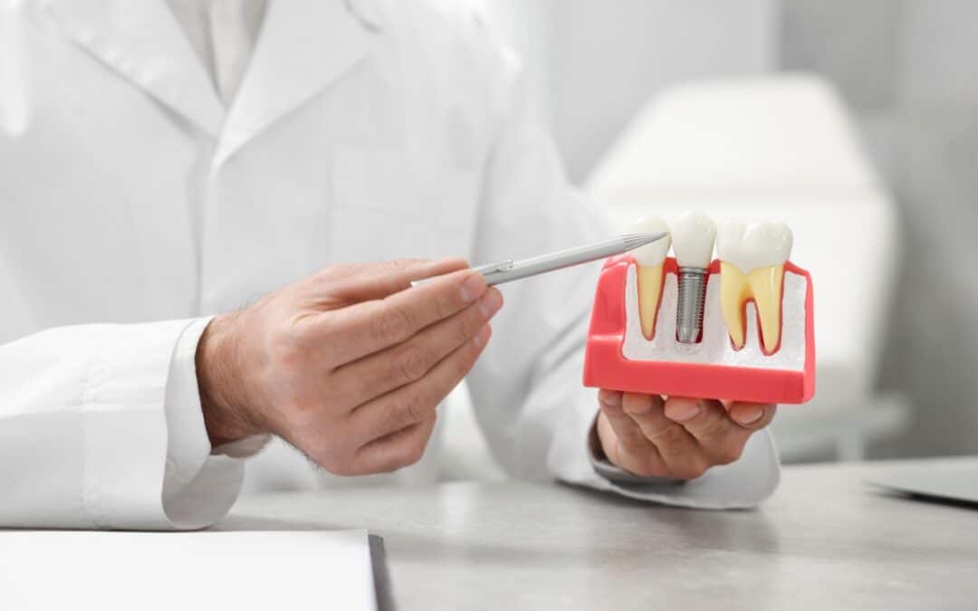 How Might Dental Implants Impact Your Sense Of Taste?