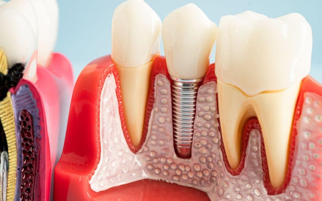 Getting Multiple Dental Implants: What to Expect in a Single Procedure?