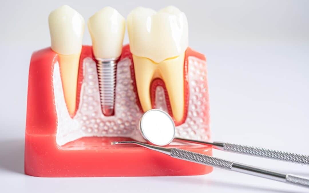 What You Should Know Before, During, and After Getting Dental Implants?
