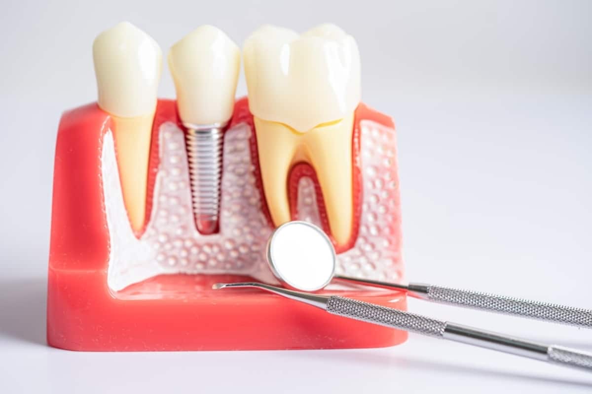 Dental Implants Colorado Springs