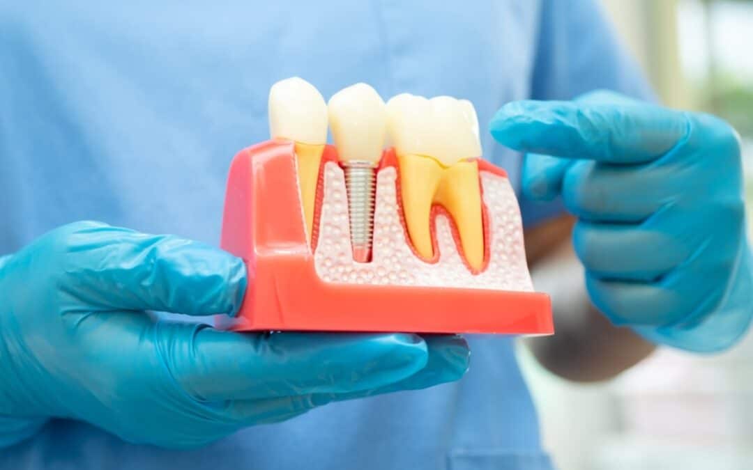 How Dental Implants Solve Missing Tooth Problems