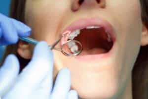 Risk After Getting Dental Implants