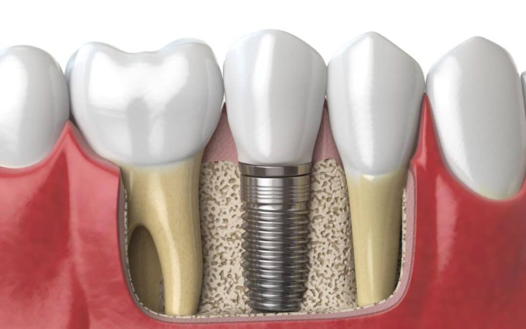 How Do Dental Implants Work And What Are Their Benefits?
