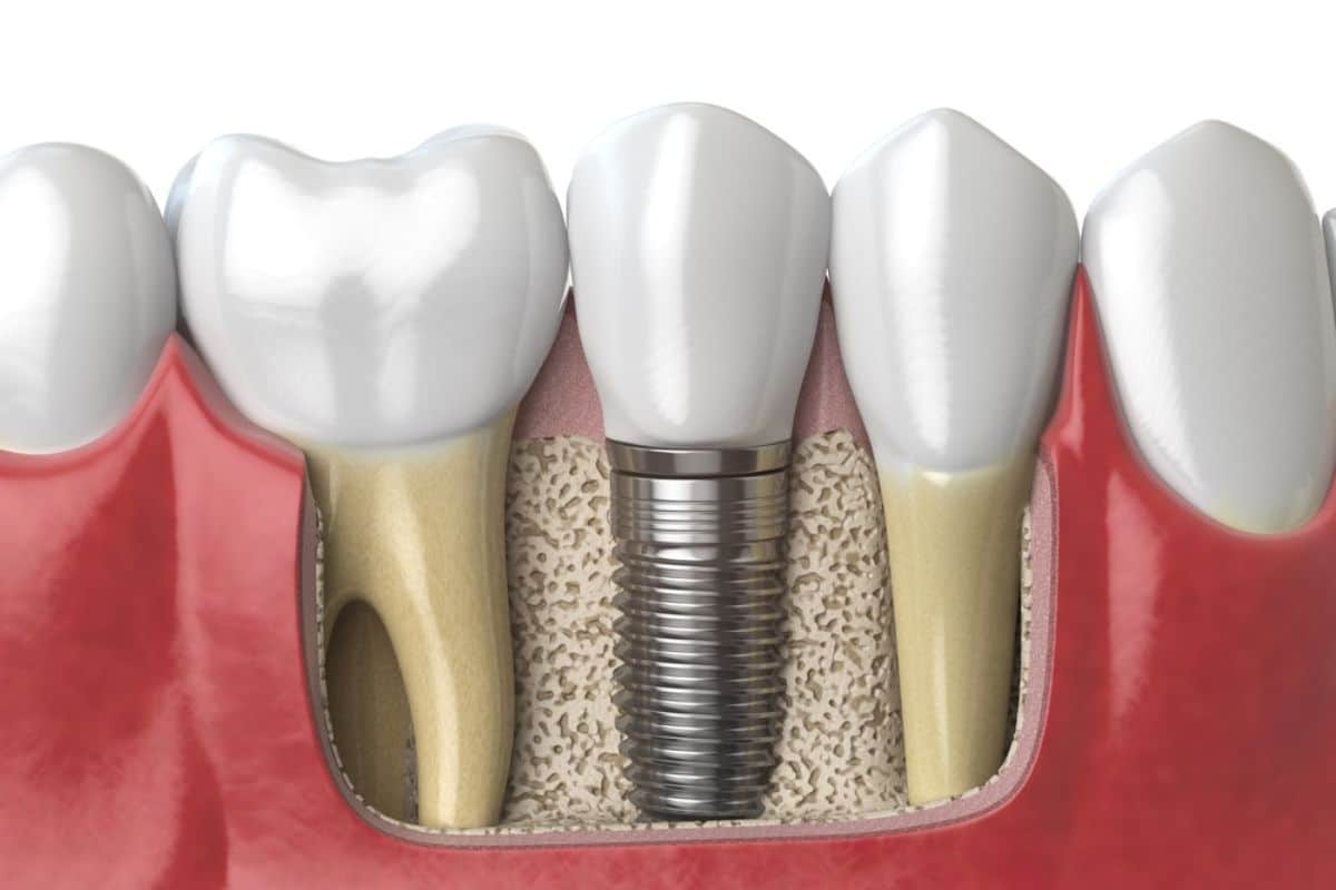 Dental Implants in Colorado Springs