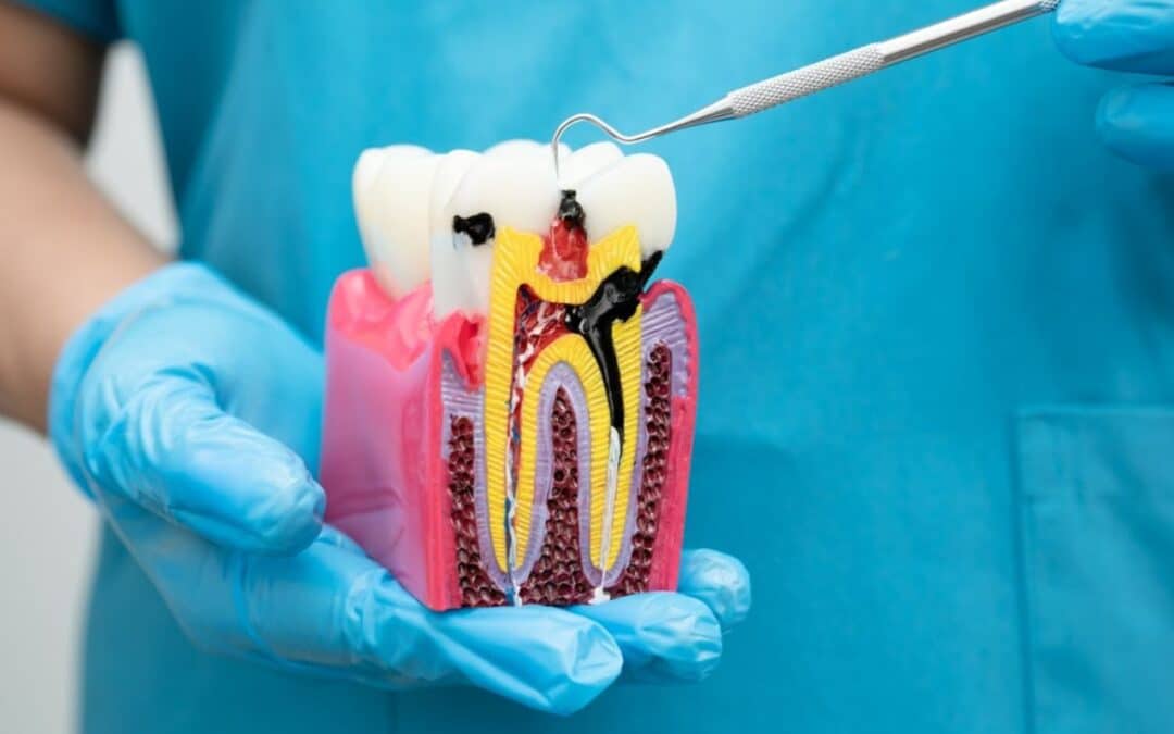 How Root Canal Can Save Your Natural Teeth
