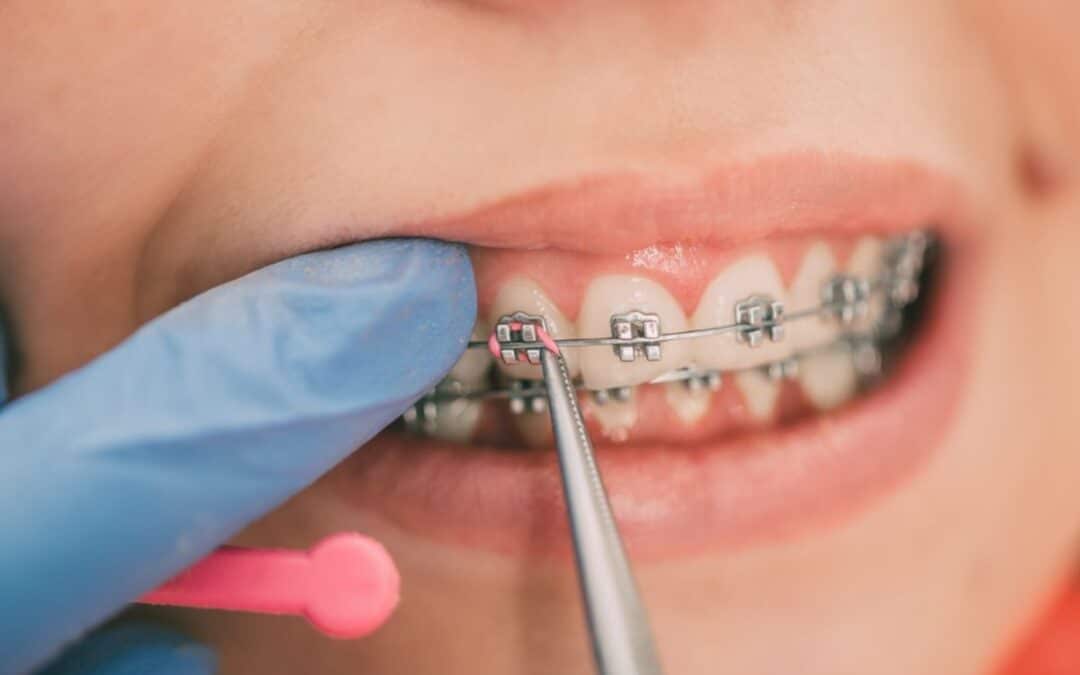 Smile Makeover At Any Age: Top Reasons Adults Choose Orthodontics