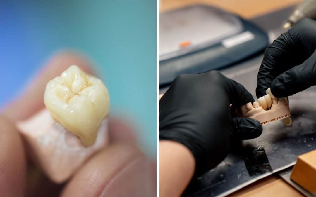 Choosing Between Veneers and Crowns: A Patient’s Guide