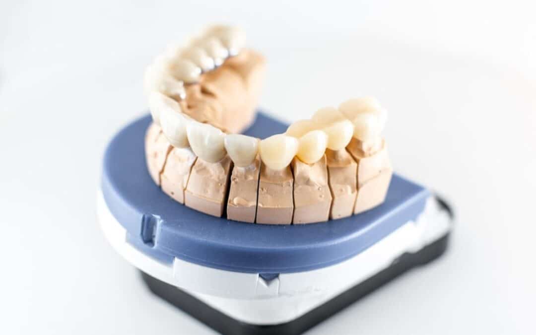 Dental Crowns: What You Need To Know About Dental Crowns