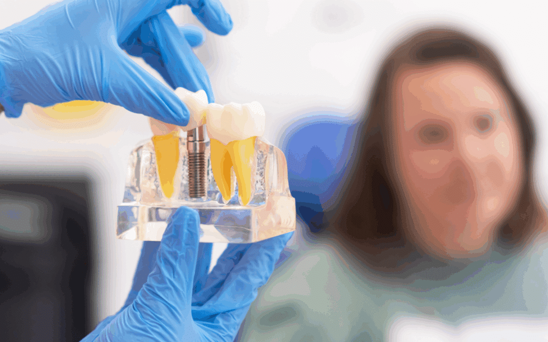 How to Care for Your Dental Implants for the Long Term?