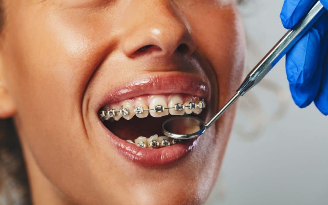 The Advantages of Surgical Orthodontics for Bite Issue Correction