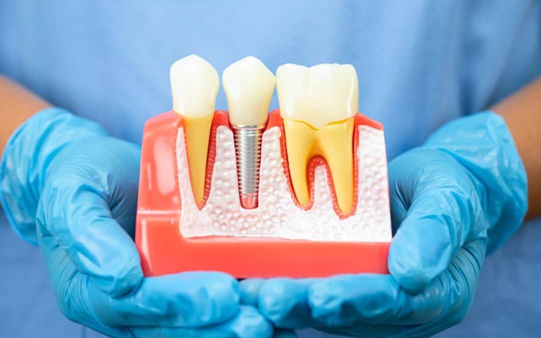 Am I A Candidate For Dental Implants Key Health Factors For Success