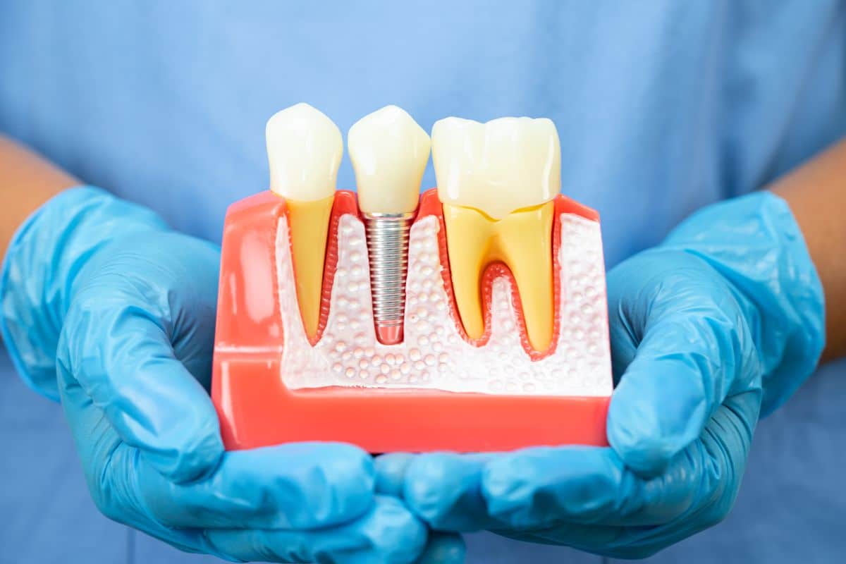 Am I A Candidate For Dental Implants Key Health Factors For Success