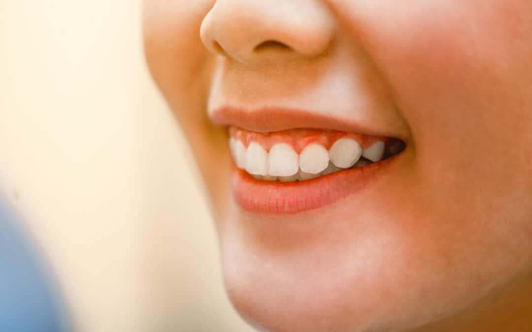 Brighten Your Smile This Holiday Season: Why Choose Professional Teeth Whitening? Expert Advice
