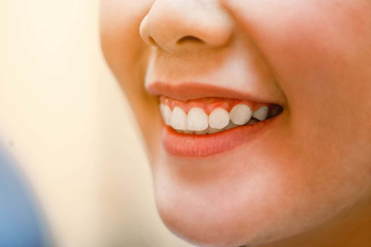Brighten Your Smile This Holiday Season Why Choose Professional Teeth Whitening Expert Advice