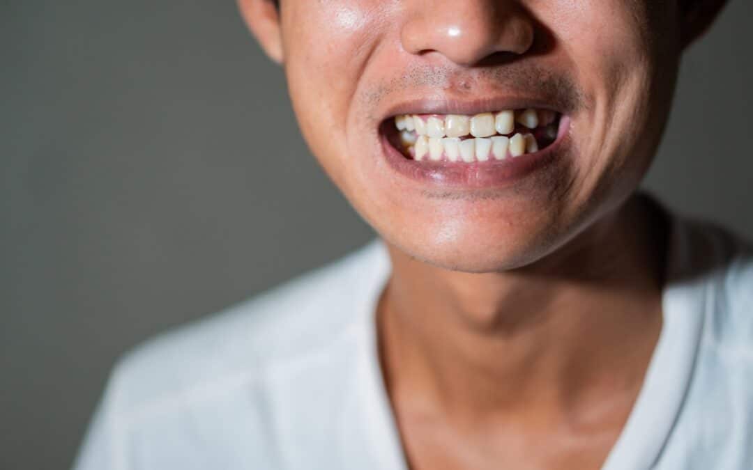 What’s The Best Way To Fix A Missing Tooth? If you In Colorado Springs