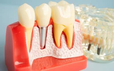 Can Dental Implants Help Prevent Premature Facial Aging?