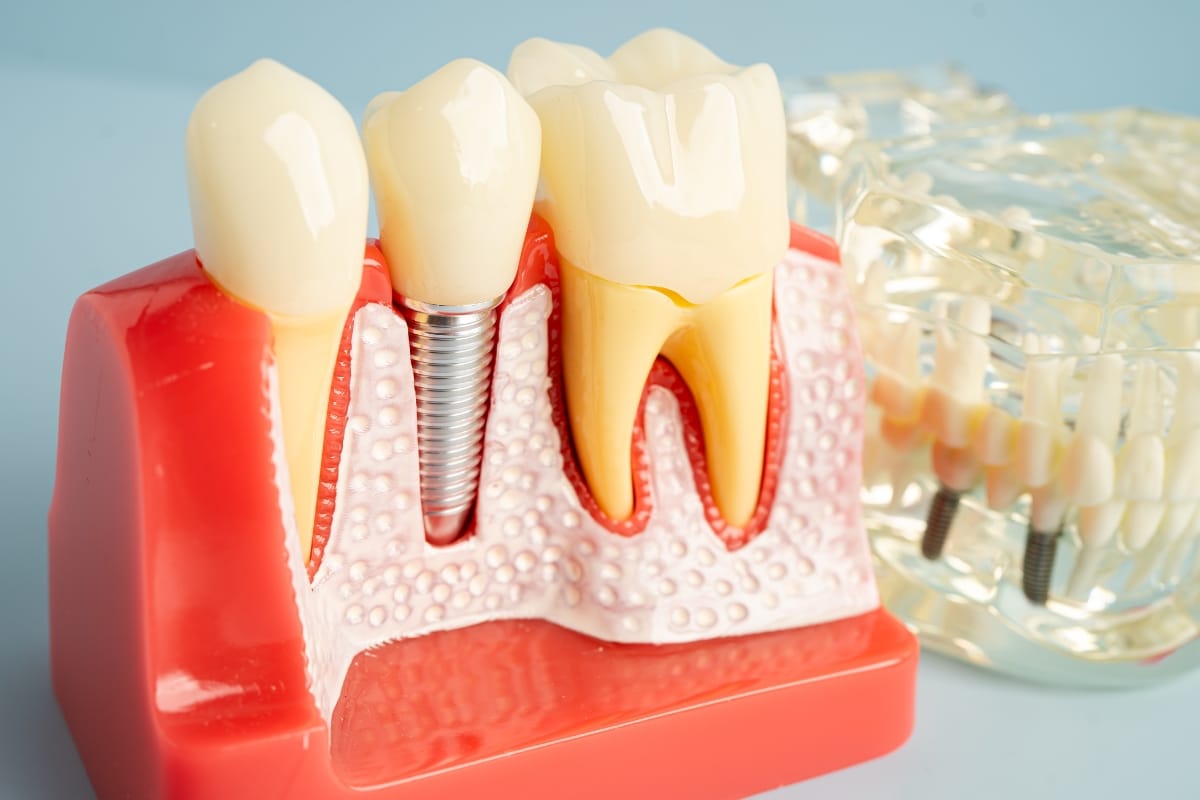 Can Dental Implants Help Prevent Premature Facial Aging