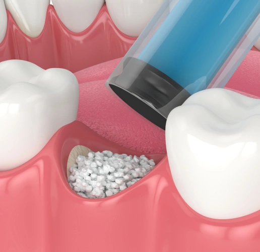 Bone grafting procedure preparing the jawbone for successful dental implant placement