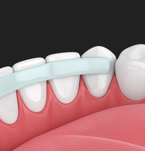 Cosmetic bonding in Colorado Springs CO repairing chipped front tooth