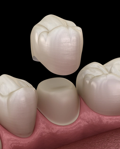 Tooth restored with a natural-looking dental crown.