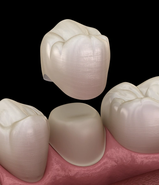 Tooth restored with a natural-looking dental crown.