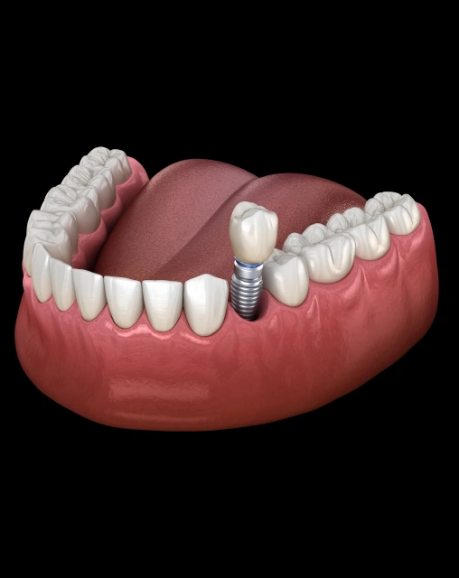 Dental implants replacing missing teeth with natural-looking, permanent restorations