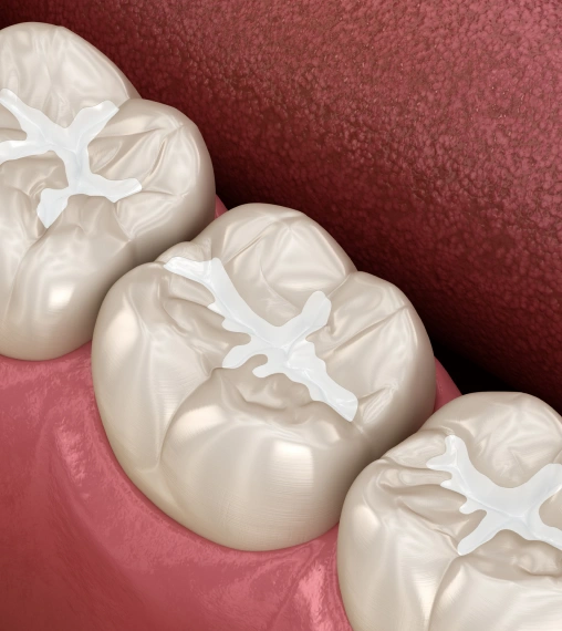 Dental sealants applied to molars to help prevent cavities and tooth decay