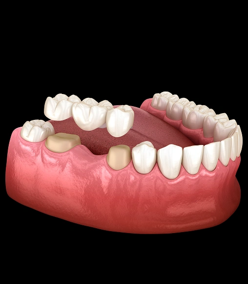 Full dentures and dental bridges restoring missing teeth and improving oral function