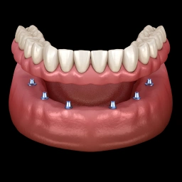 Implant-supported dentures offering enhanced stability, comfort, and function