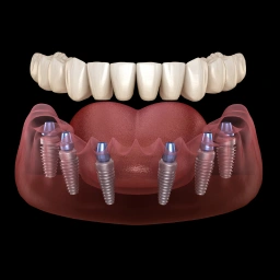 Overdentures secured with dental implants for improved comfort and confidence