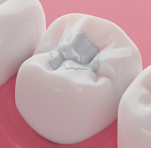Tooth-colored dental filling restoring a cavity with a natural-looking appearance