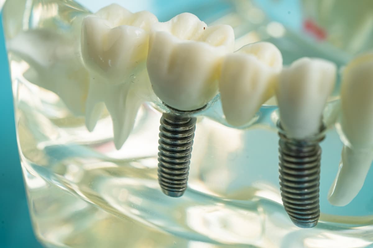 Discover Implant-Supported Dentures in Colorado Springs