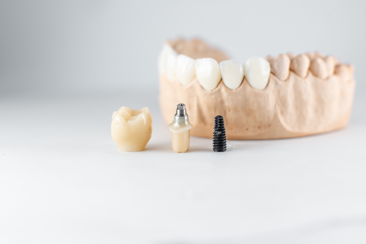 Dental Implants in Colorado Springs