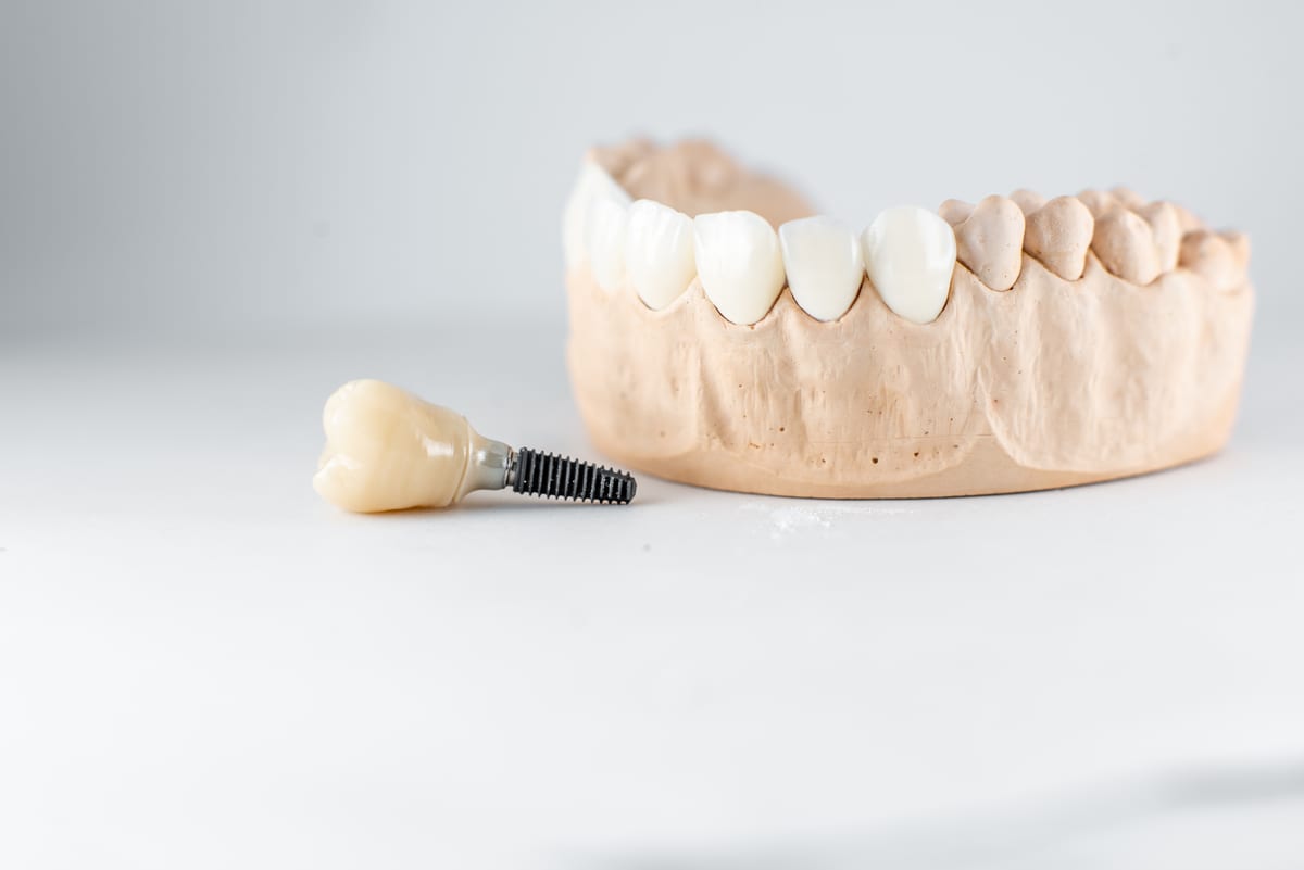 Dental Implants in Colorado Springs